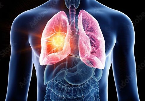 Traitement du cancer du poumon par le GROP